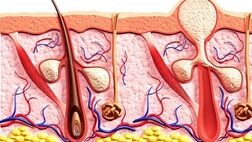 چگونه می‌توان از ایجاد کورک جلوگیری کرد؟
