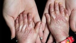 پانسمان ویژه‌ بیماران پروانه‌ای شامل تعهدات سازمان‌های بیمه‌گر پایه نیست