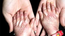 پانسمان ویژه‌ بیماران پروانه‌ای شامل تعهدات سازمان‌های بیمه‌گر پایه نیست