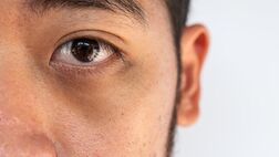 چه عواملی باعث تیرگی دور چشم می‌شوند؟
