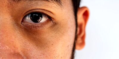 چه عواملی باعث تیرگی دور چشم می‌شوند؟