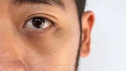 چه عواملی باعث تیرگی دور چشم می‌شوند؟
