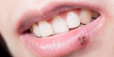 ۷ خوراکی مفید برای کاهش خطر انتقال ویروس تبخال

