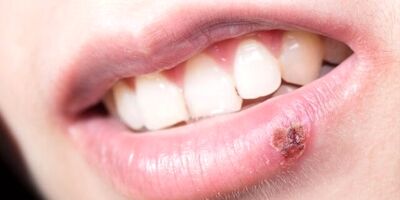 ۷ خوراکی مفید برای کاهش خطر انتقال ویروس تبخال
