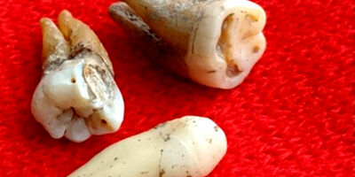 پادتن‌ استخراج‌شده از دندان‌های ۸۰۰ ساله به شناخت بیماری‌ها کمک می‌کند