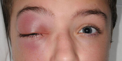 «سلولیت چشمی» چیست؟