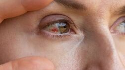 دلایل پارگی رگ خونی در چشم؛ چه موقع باید به پزشک مراجعه کنیم؟
