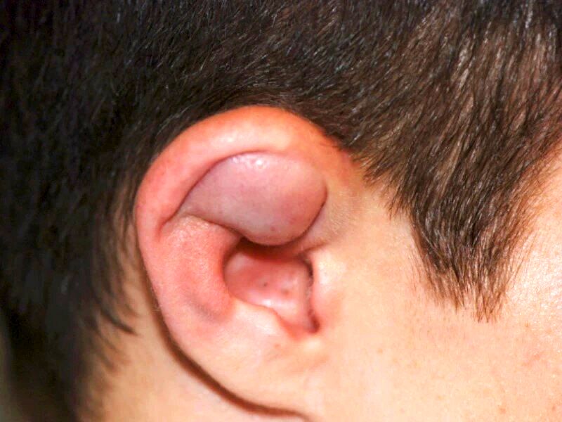 سرطان لاله گوش چیست و چه علائمی دارد؟
