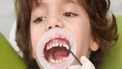 فلوراید برای سلامت دندان‌ها ضروری است
