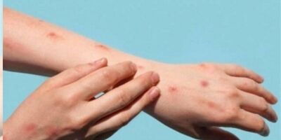 علائم و نحوه انتقال آبله میمونی