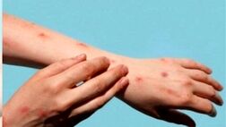 علائم و نحوه انتقال آبله میمونی