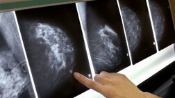 فاکتور پرخطر احتمالی سرطان سینه شناسایی شد