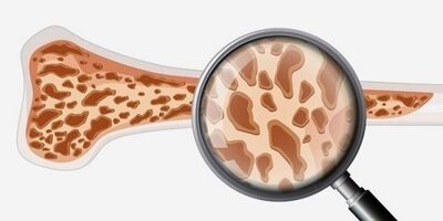 پوکی استخوان چیست و چرا مهم است؟
