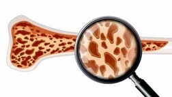پوکی استخوان چیست و چرا مهم است؟
