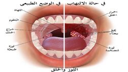 فواید سیر و زنجبیل برای التهاب لوزه‌ها چیست؟