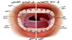 فواید سیر و زنجبیل برای التهاب لوزه‌ها چیست؟