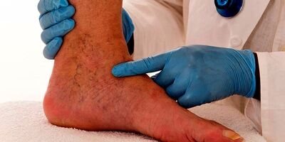 شاغلان در معرض ابتلا به واریس