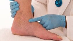 شاغلان در معرض ابتلا به واریس