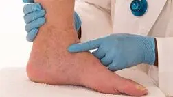 شاغلان در معرض ابتلا به واریس