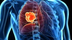 نکاتی درباره سرطان ریه
