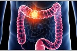 ۴ علامت اولیه سرطان روده بزرگ که جوانان باید بدانند
