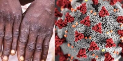 آبله میمونی یک وضعیت اضطراری جهانی نیست