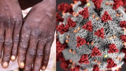 آبله میمونی یک وضعیت اضطراری جهانی نیست