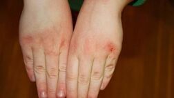 چگونه از خشکی شدید پوست در سرما جلوگیری کنیم؟
