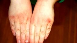 چگونه از خشکی شدید پوست در سرما جلوگیری کنیم؟
