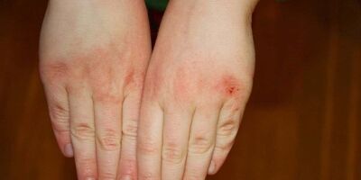 چگونه از خشکی شدید پوست در سرما جلوگیری کنیم؟
