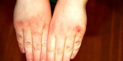 چگونه از خشکی شدید پوست در سرما جلوگیری کنیم؟
