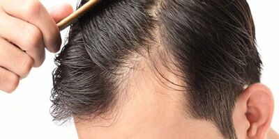 چه زمانی ریزش مو غیرطبیعی است؟
