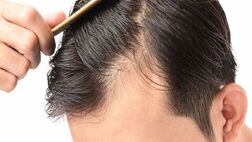 چه زمانی ریزش مو غیرطبیعی است؟
