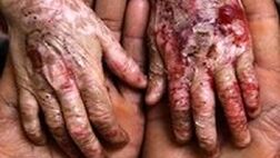 بیماران ای بی و ام اس تحت پوشش تامین اجتماعی