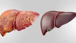 بیماری کبدی کودکان خطر ابتلا به دیابت نوع ۲ را افزایش می دهد