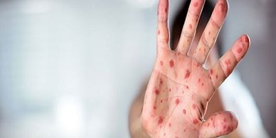 واکسن کووید، سلامت کودکان مبتلا به اگزما را بهبود می‌بخشد
