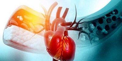 استرس احتمال فیبریلاسیون دهلیزی را در زنان یائسه افزایش می دهد
