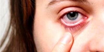 راه حل مناسب برای  درمان عارضه چشم صورتی چیست؟