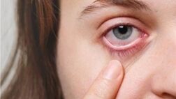 راه حل مناسب برای  درمان عارضه چشم صورتی چیست؟