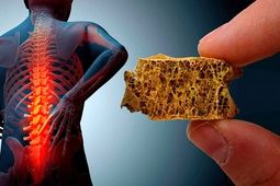 چگونه به پوکی استخوان مبتلا نشویم؟