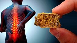 چگونه به پوکی استخوان مبتلا نشویم؟