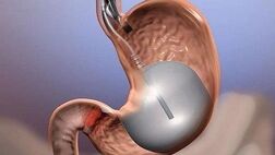 جراحی کاهش وزن باعث افزایش طول عمر می شود