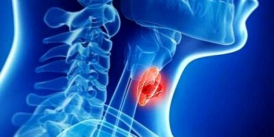 تاثیر چاقی بر بالا رفتن ریسک سرطان تیروئید در سال های آینده