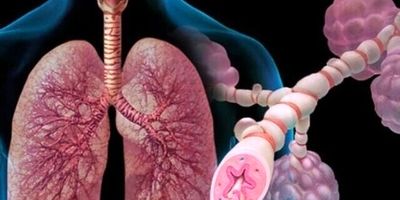 کاهش چشمگیر حملات آسم با داروی جدید