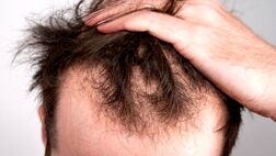 چرا با بالا رفتن سن، ریزش مو بیشتر می‌شود؟ + راهکارهای پیشگیری و درمان