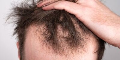 کمبود ویتامین‌ها چگونه باعث ریزش مو می‌شود؟