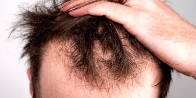 کمبود ویتامین‌ها چگونه باعث ریزش مو می‌شود؟