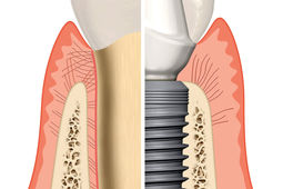 کاشت دندان طبیعی چیست ؟ ( قیمت کاشت دندان طبیعی )
