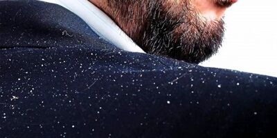 ریزش شدید موی سر 4 ماه پس از بیماری‌های شدید تب دار رخ می دهد