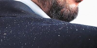 ریزش شدید موی سر 4 ماه پس از بیماری‌های شدید تب دار رخ می دهد
